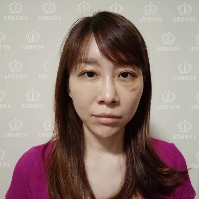 法喬醫美診所自體脂肪豐臉術後10天