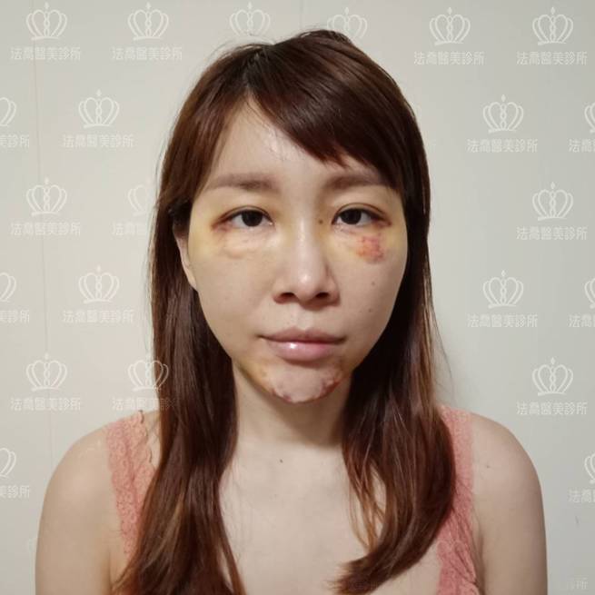 法喬醫美診所自體脂肪豐臉術後7天