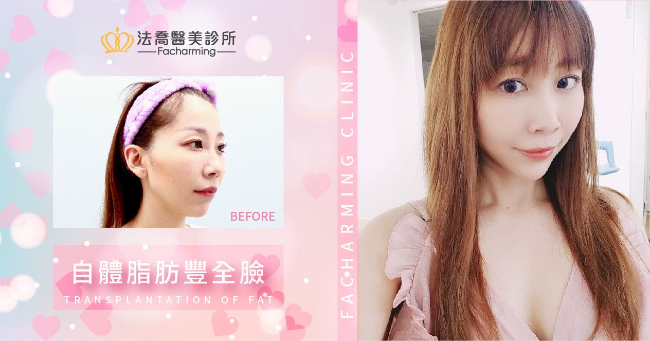 法喬醫美診所-自體脂肪豐全臉權威唐文瑞醫師