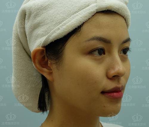 /files/images/案例分享/皮秒雷射/李李涵/術前_左側.jpg?1568946847 法喬醫美診所_皮秒雷射PICOCARE