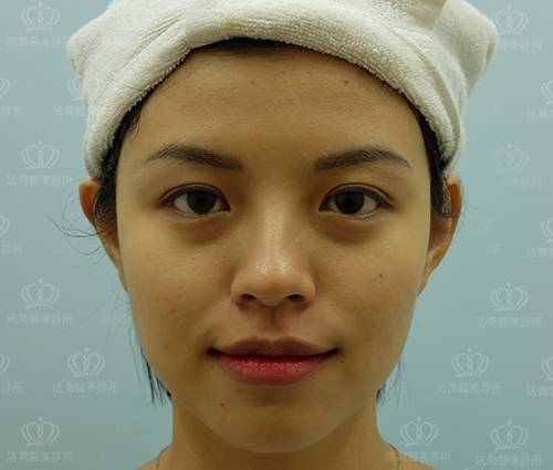 /files/images/案例分享/皮秒雷射/李李涵/術前_正面.jpg?1568946846 法喬醫美診所_皮秒雷射PICOCARE