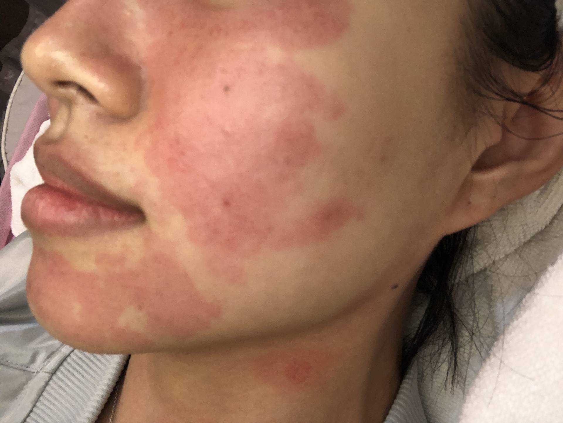 /files/images/案例分享/皮秒雷射/李李涵/10142812463581.jpg?1568974233 高雄法喬醫美_皮秒療程後