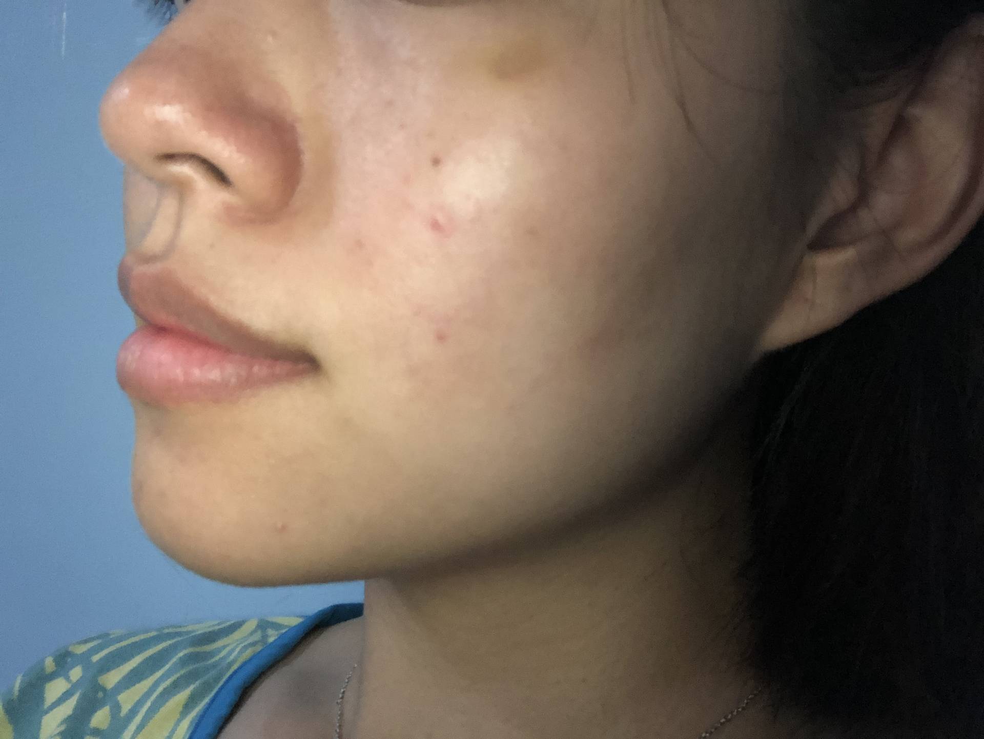 /files/images/案例分享/皮秒雷射/李李涵/10142812564968.jpg 高雄法喬醫美_皮秒療程後