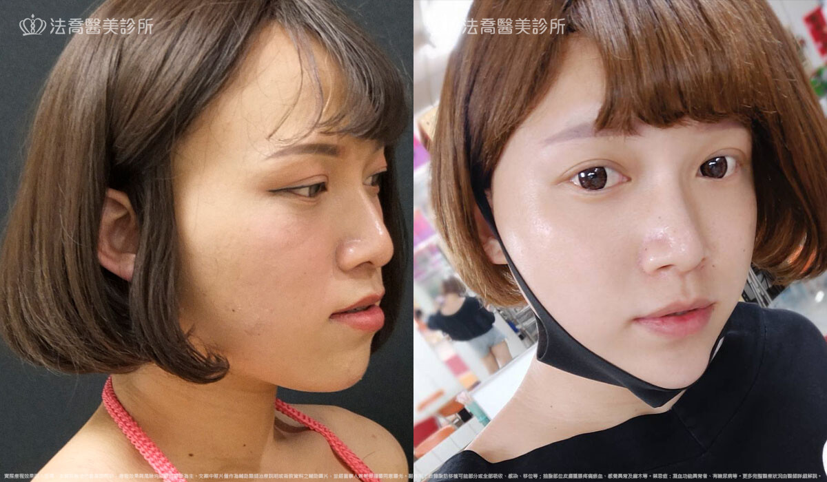 PICOCARE 皮秒雷射 術後一個月