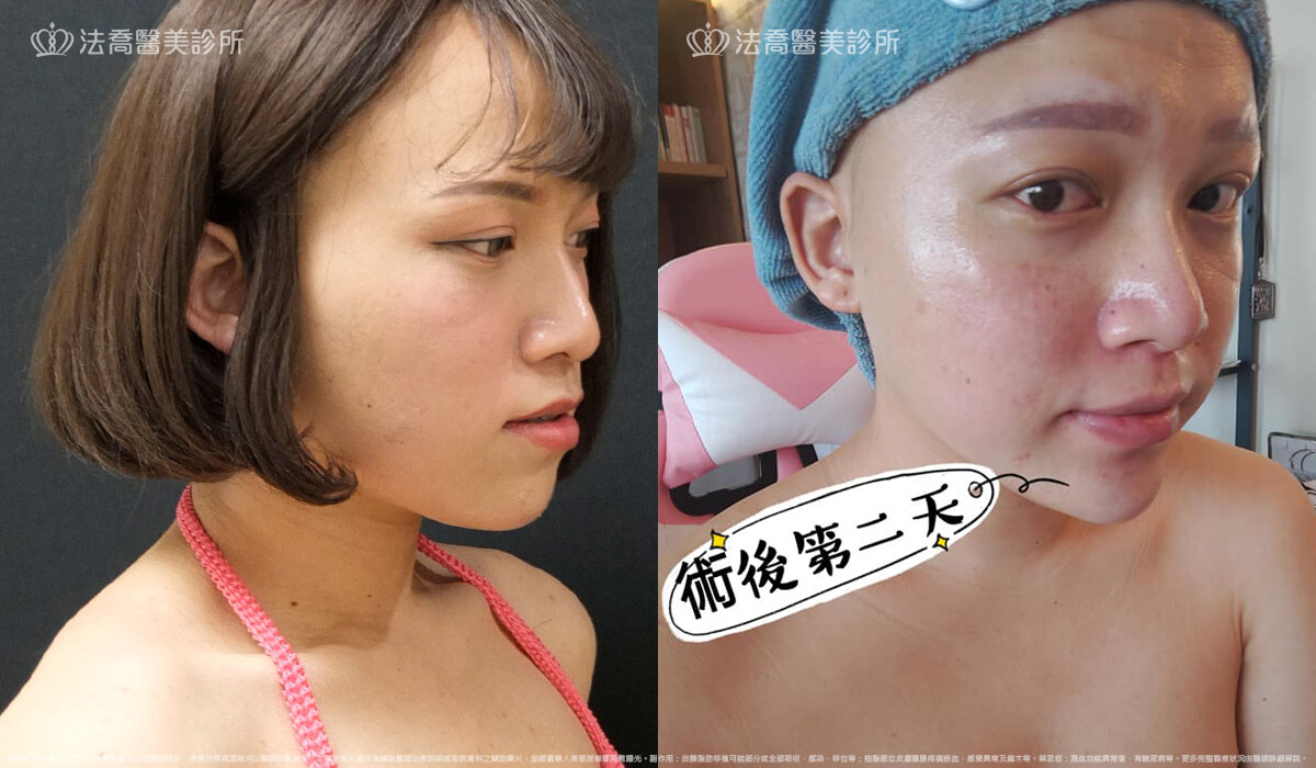 PICOCARE 皮秒雷射 術後第二天