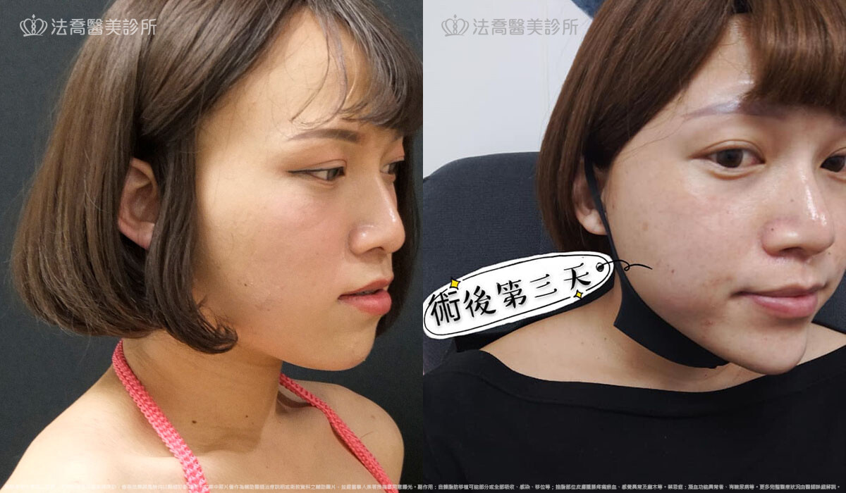 PICOCARE 皮秒雷射 術後第三天