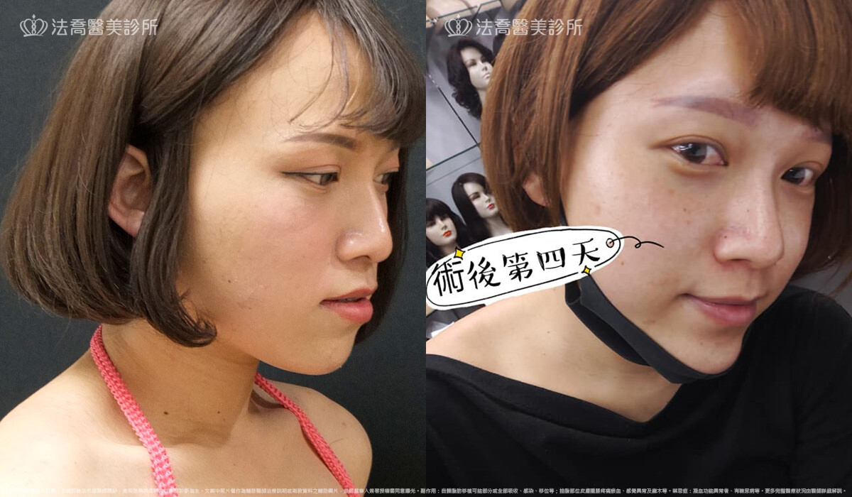 PICOCARE 皮秒雷射 術後第四天