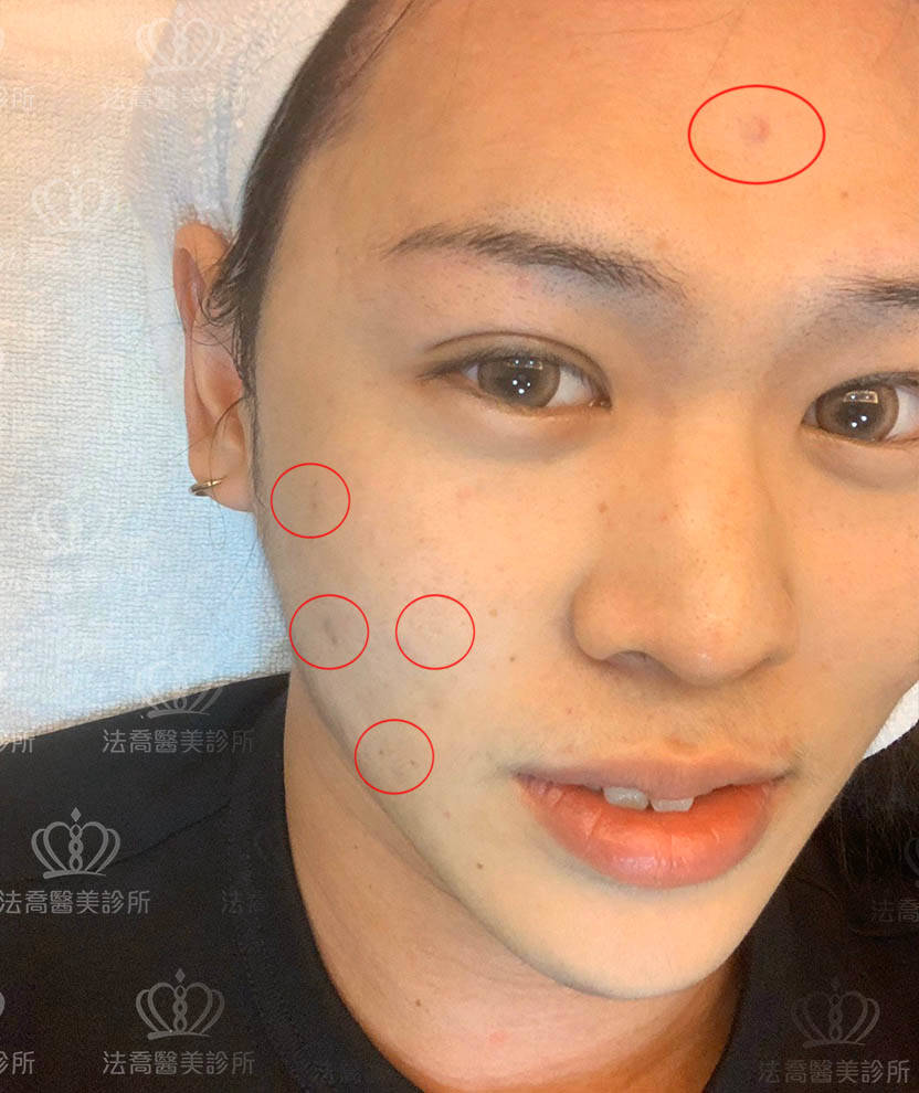 法喬醫美診所-皮秒雷射術前案例