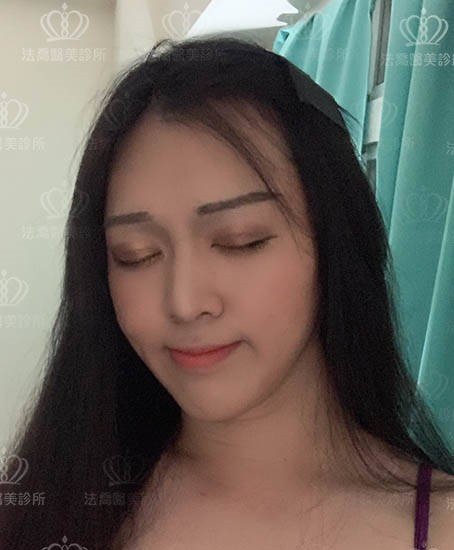 法喬醫美皮秒術後案例
