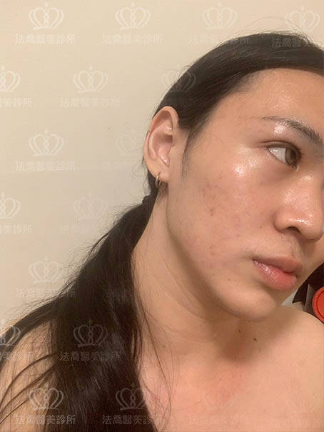 法喬醫美皮秒術後案例