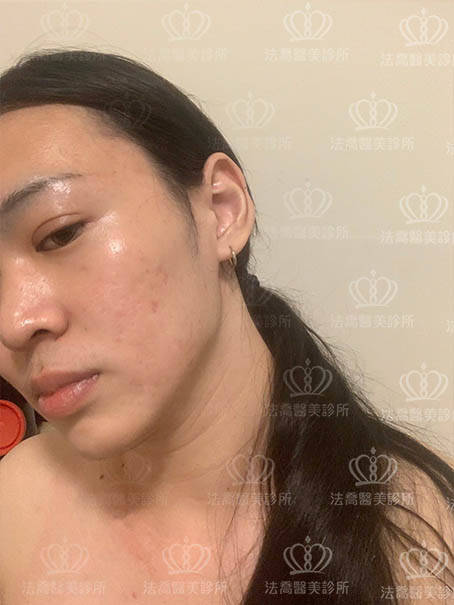 法喬醫美皮秒術後案例