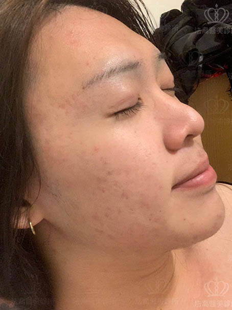 法喬醫美皮秒術前後案例