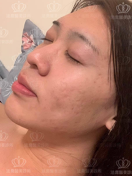 法喬醫美皮秒術後案例