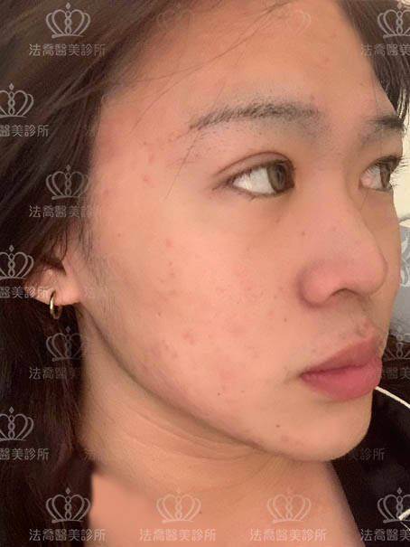 法喬醫美皮秒術後案例