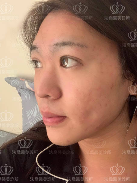 法喬醫美皮秒術後案例