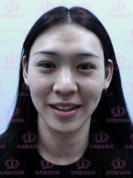 法喬醫美皮秒術前案例