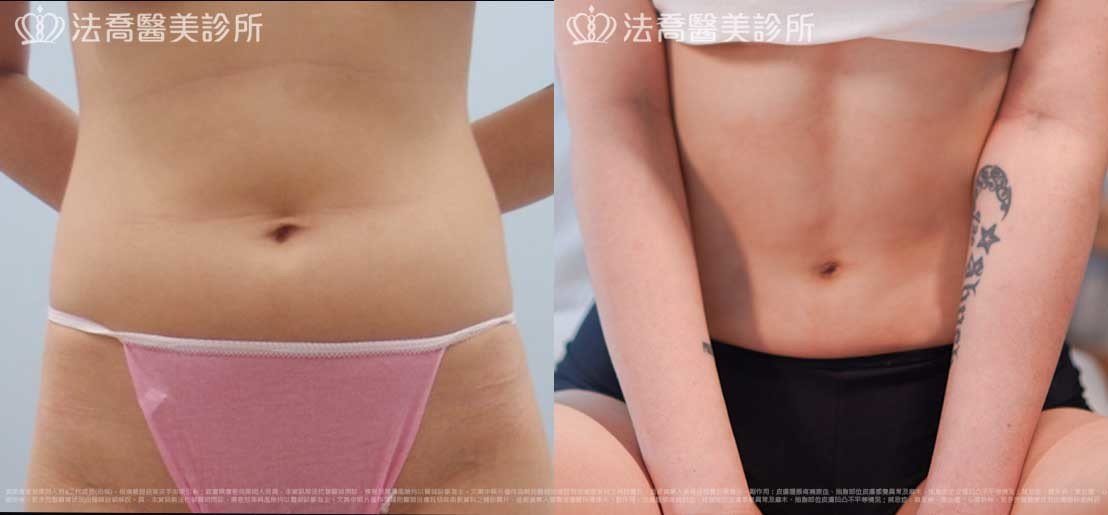 法喬醫美診所,邱浚彥,威塑抽脂
