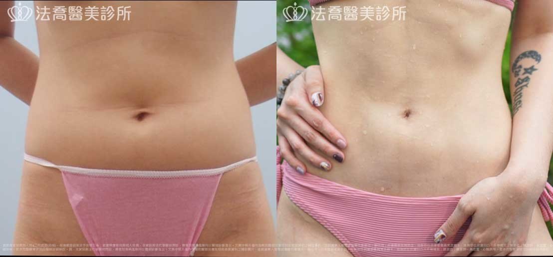 法喬醫美診所,邱浚彥,威塑抽脂