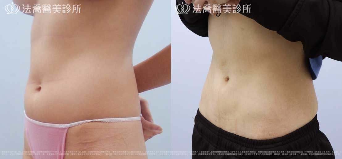 法喬醫美診所,邱浚彥,威塑抽脂
