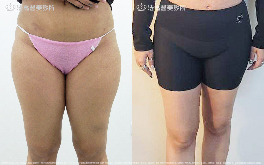抽脂手術