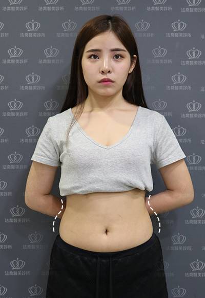 法喬醫美威塑Vaser抽脂案例BA圖