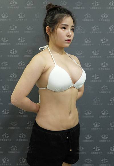 法喬醫美威塑Vaser抽脂案例BA圖