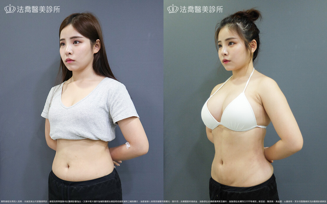 威塑豐胸補脂