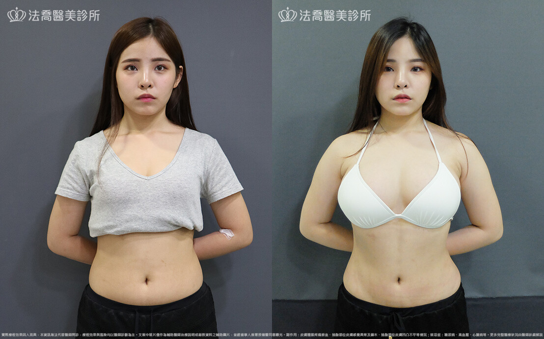 抽脂