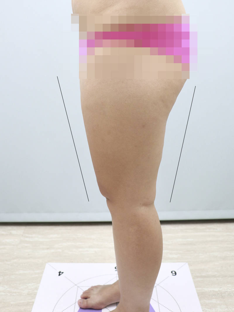 法喬醫美威塑Vaser抽脂案例BA圖