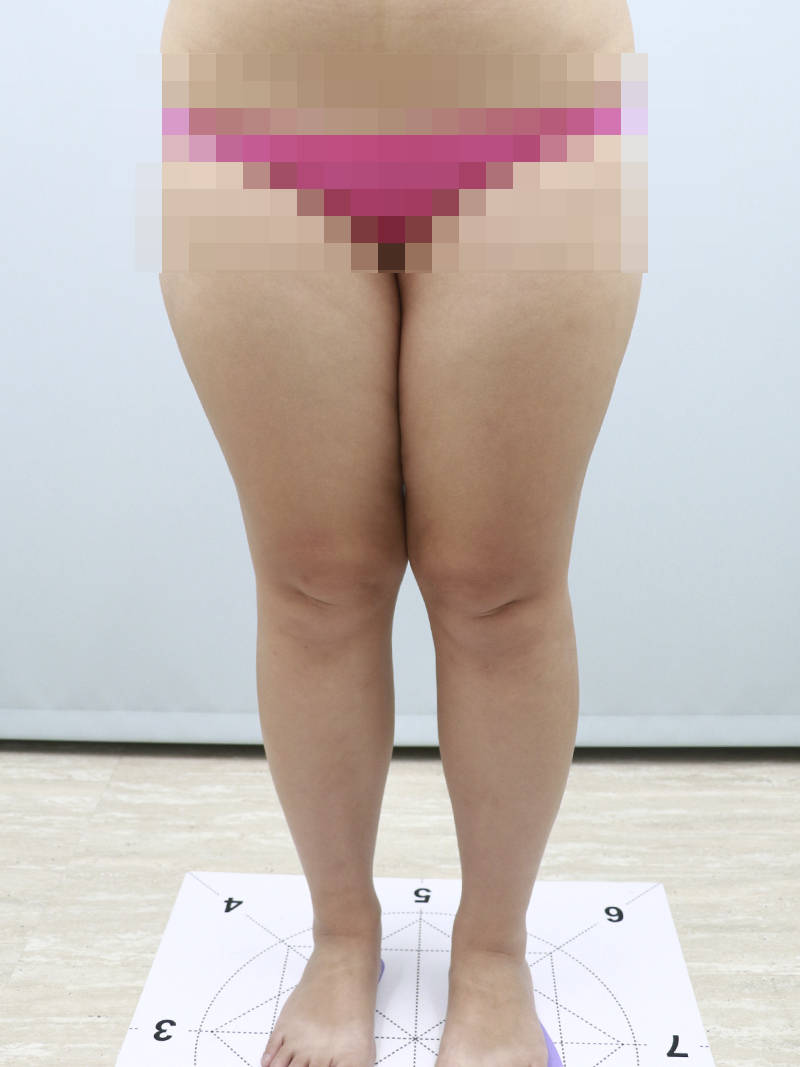 法喬醫美威塑Vaser抽脂案例BA圖
