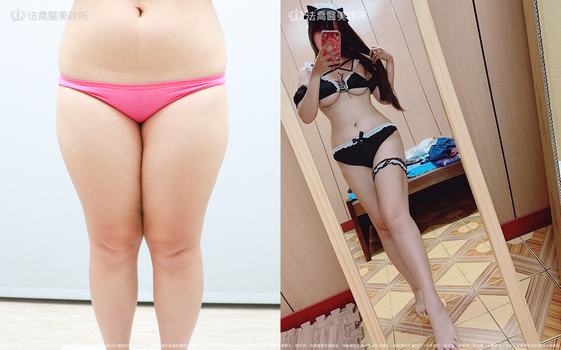 法喬醫美診所,邱浚彥,威塑大腿環抽