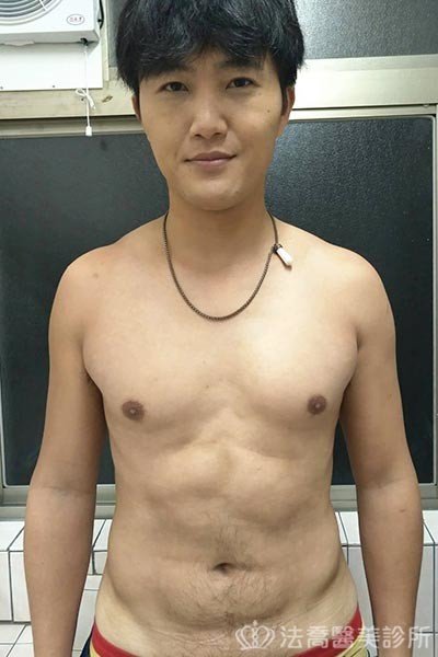 法喬威塑腹部環抽雕塑術後案例