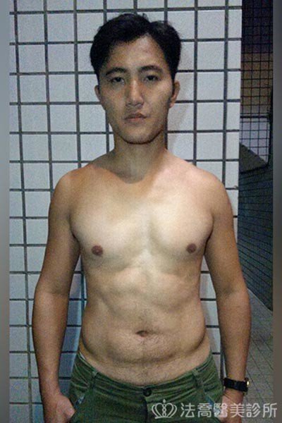 法喬威塑腹部環抽雕塑術後案例