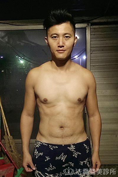 法喬威塑腹部環抽雕塑術後案例