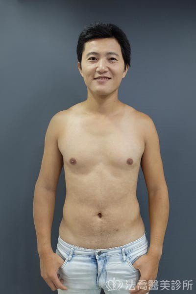 法喬威塑腹部環抽雕塑術後案例