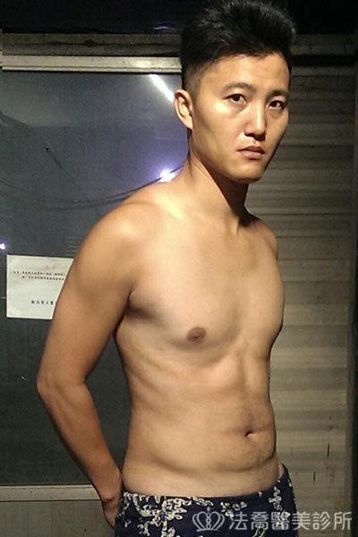 法喬威塑腹部環抽雕塑術後案例