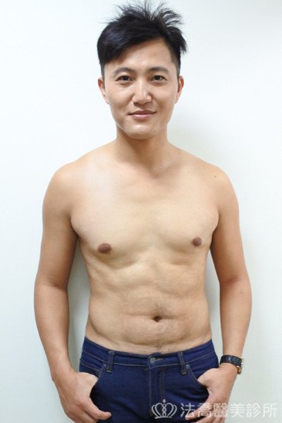 法喬威塑腹部環抽雕塑術後案例