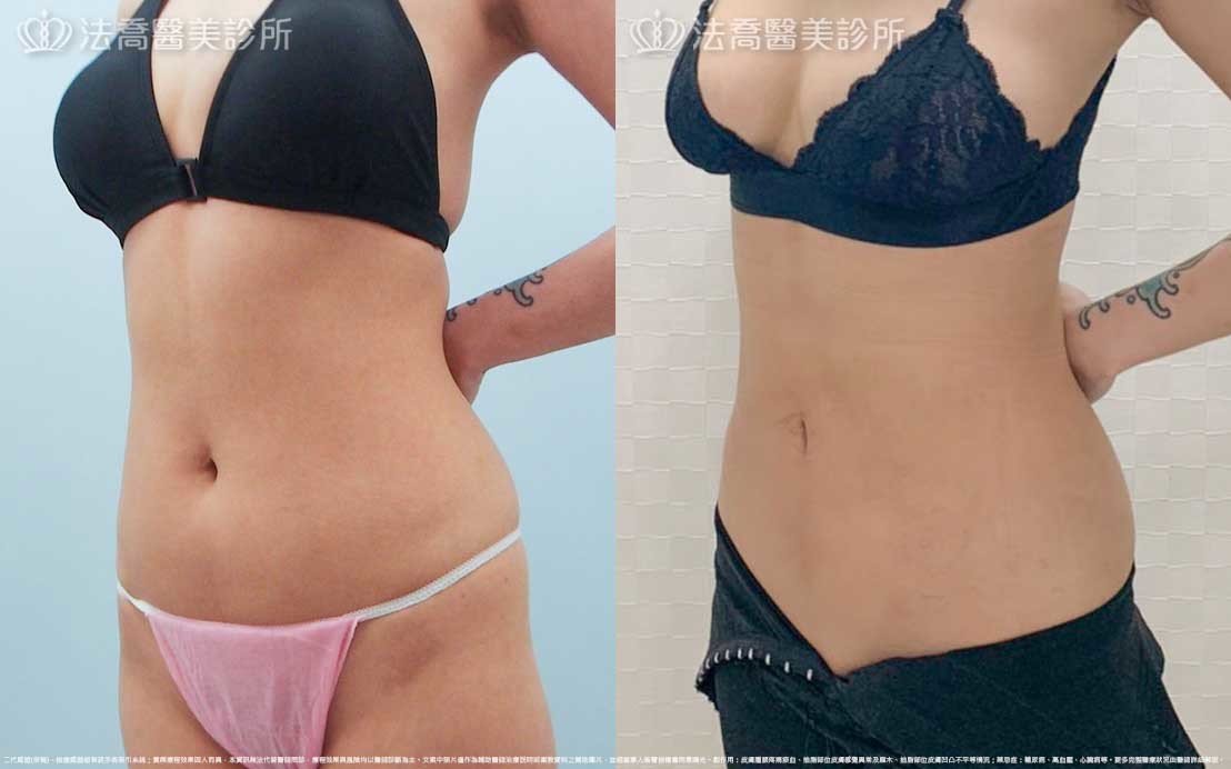高雄法喬醫美,邱浚彥,張慈恩,威塑抽脂
