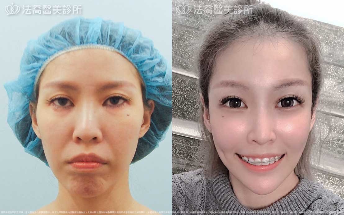高雄法喬醫美,邱浚彥,張慈恩,威塑抽脂
