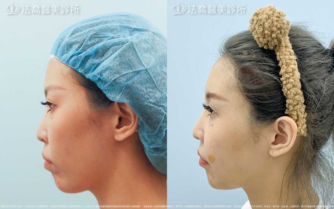 高雄法喬醫美,邱浚彥,張慈恩,威塑抽脂