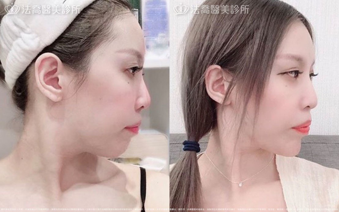 高雄法喬醫美,邱浚彥,張慈恩,威塑抽脂