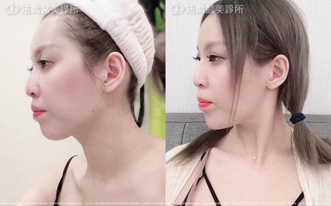 高雄法喬醫美,邱浚彥,張慈恩,威塑抽脂