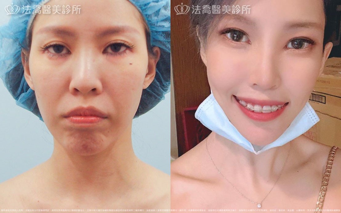 高雄法喬醫美,邱浚彥,張慈恩,威塑抽脂
