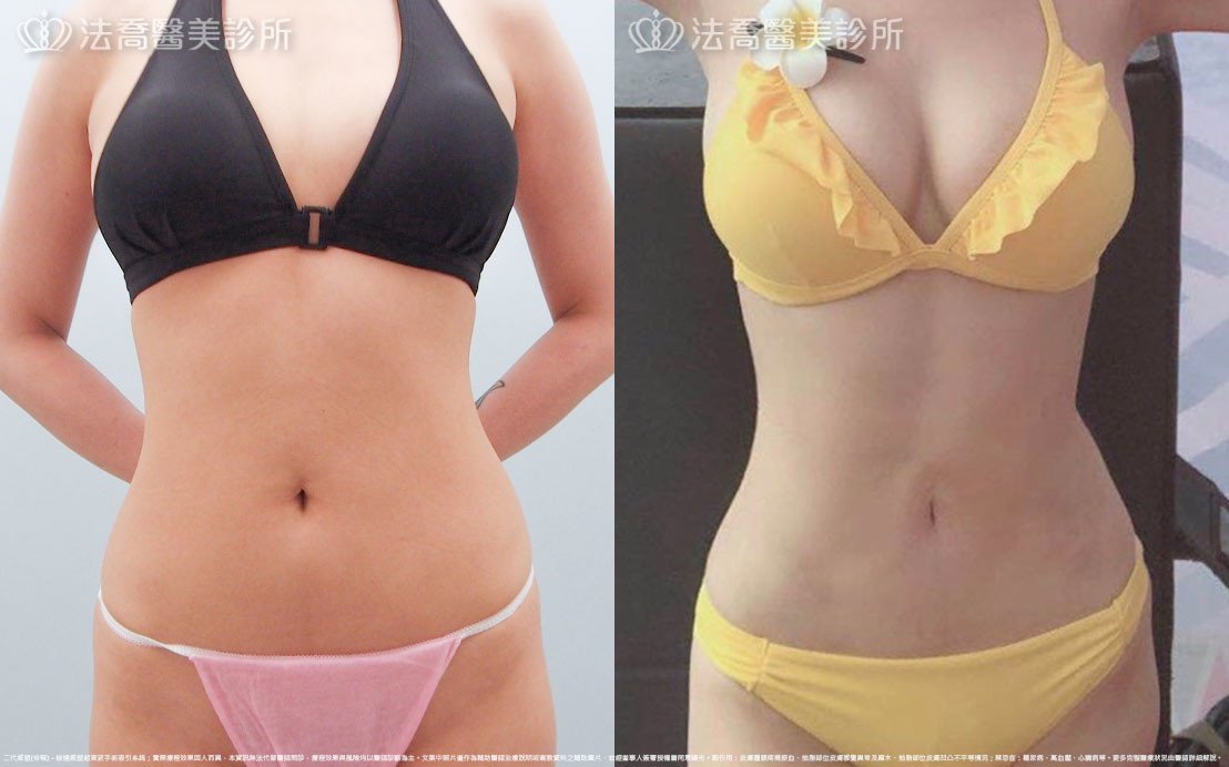 高雄法喬醫美,邱浚彥,張慈恩,威塑抽脂