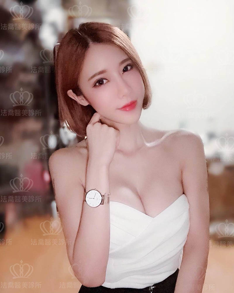 法喬醫美診所_微整就找張慈恩醫師藍鑽魚骨線埋線拉提術後2周案例照