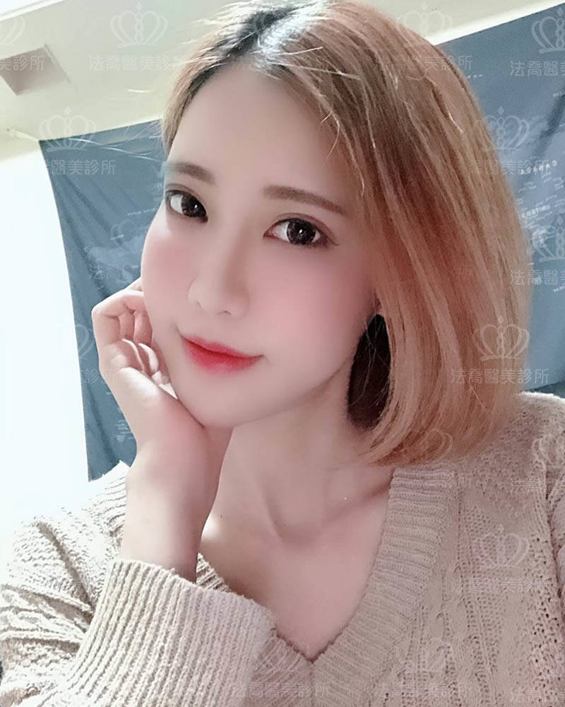 法喬醫美診所_微整就找張慈恩醫師指定藍鑽魚骨線埋線拉提術後2周案例照
