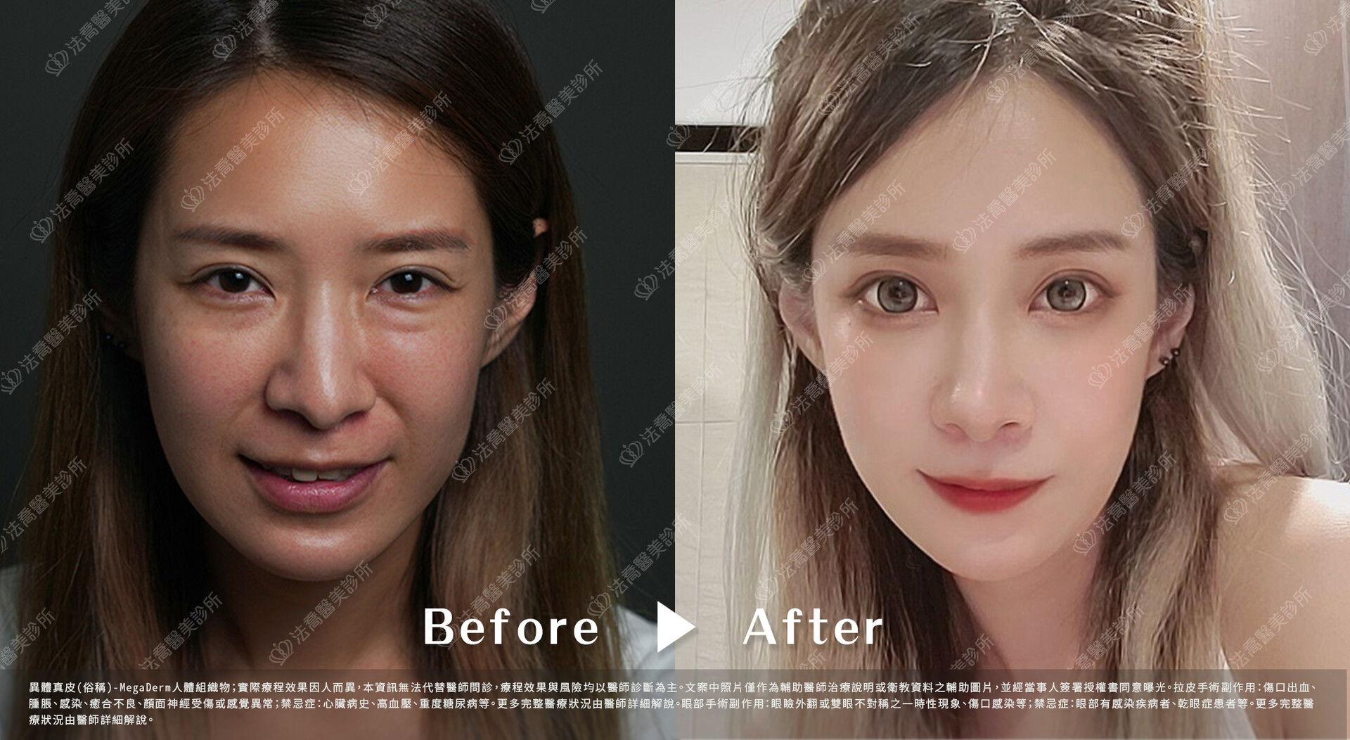 異體真皮鼻唇溝 術前與術後1個月