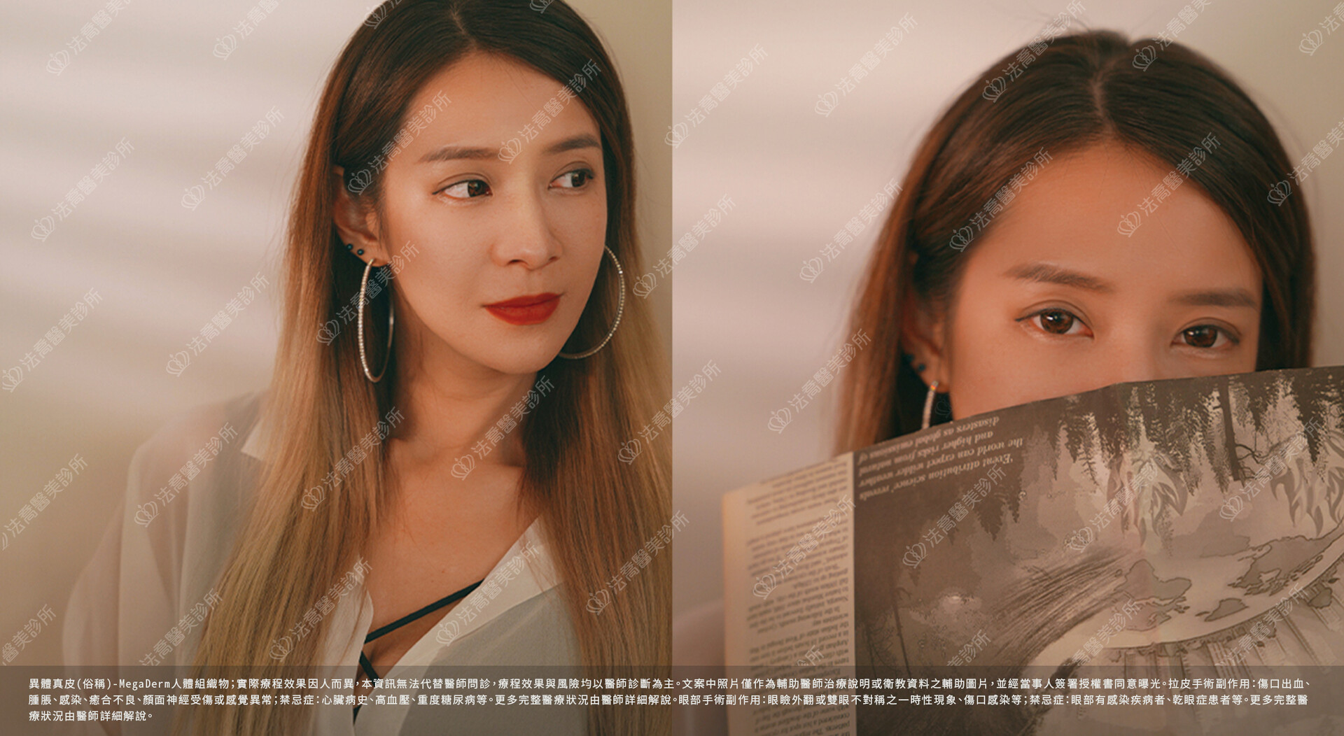 眼袋內開、脂肪移位 / 術後3個月