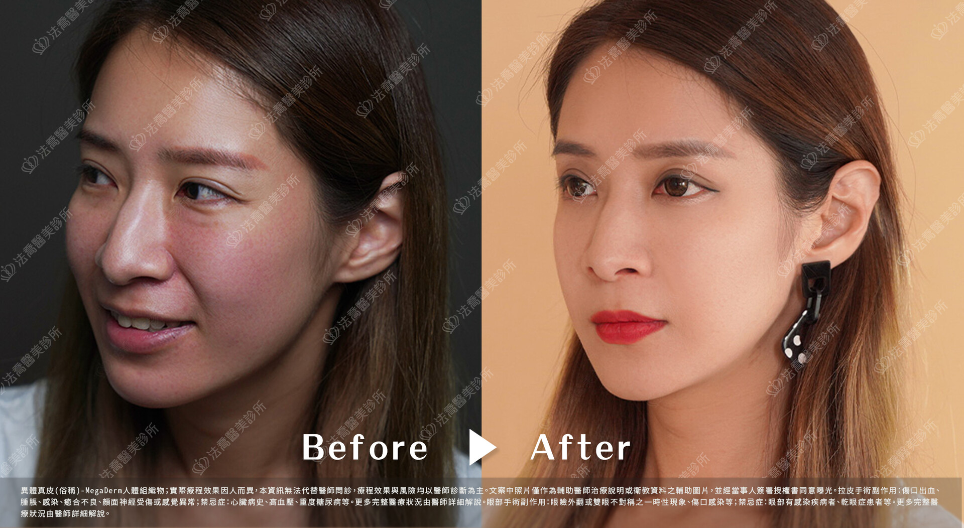 異體真皮鼻唇溝(法令)填補術 術前與術後3個月