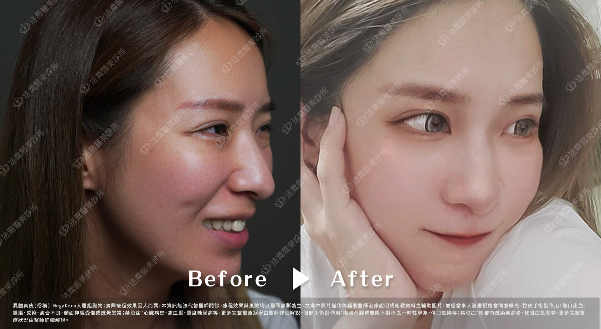 異體真皮鼻唇溝 術前與術後1個月